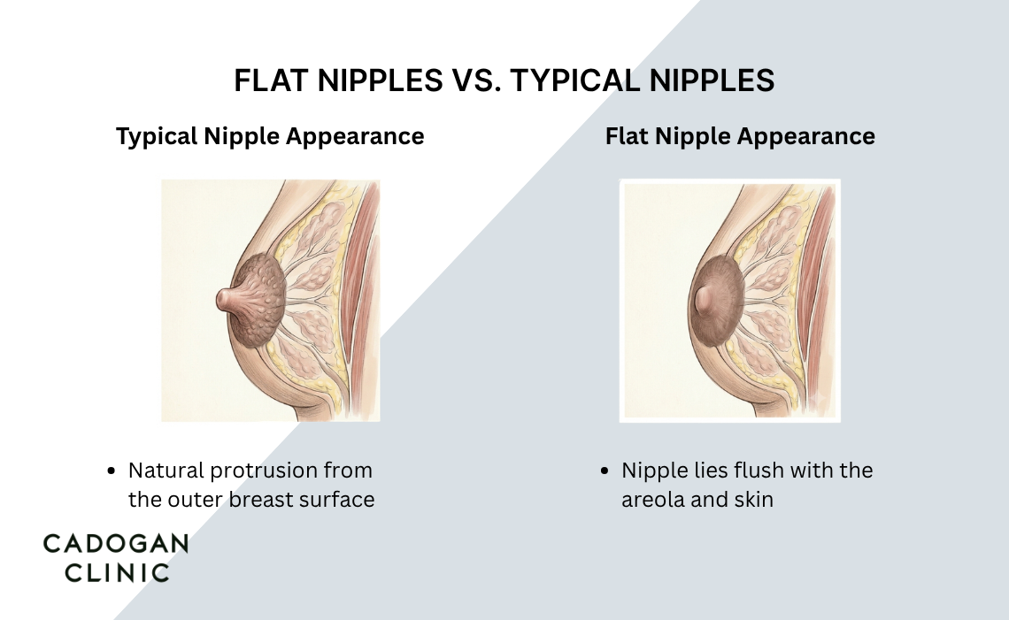An infographic showing the differences between a typical nipple appearance, and a flat nipple